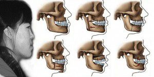 Tìm lại nét thẩm mỹ cho hàm móm