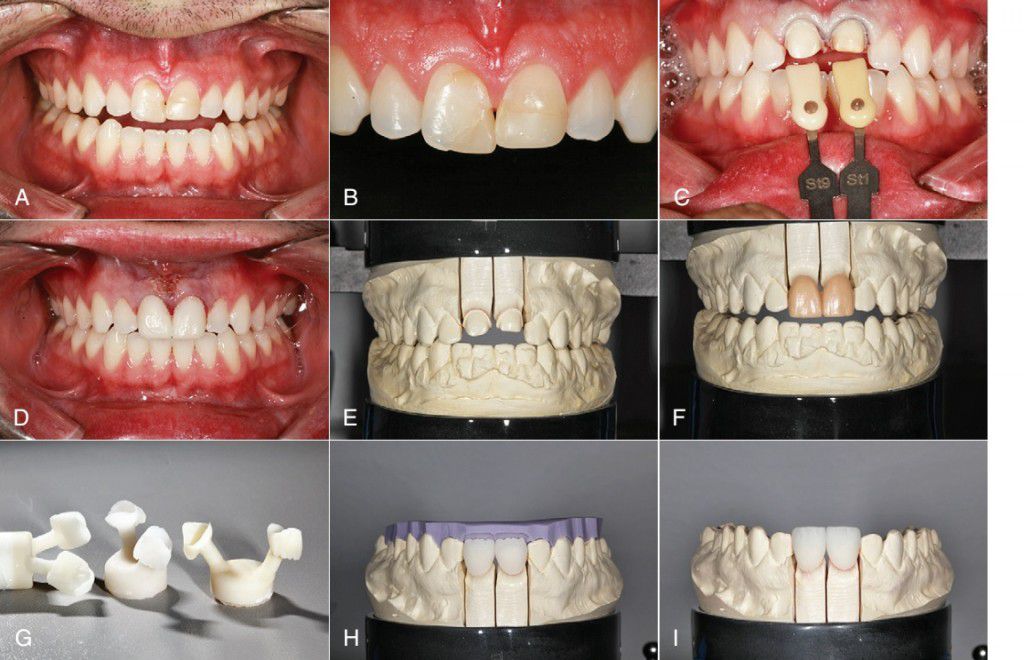 Cách chỉnh răng cửa 3