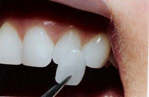 Mặt dán Veneer sứ - Phục hình thẩm mỹ răng thật