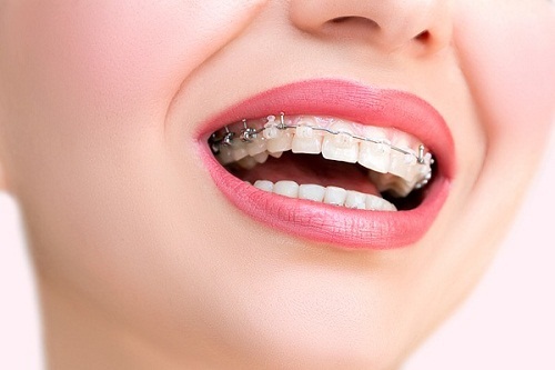 Các phương pháp niềng răng hô hàm dưới-1