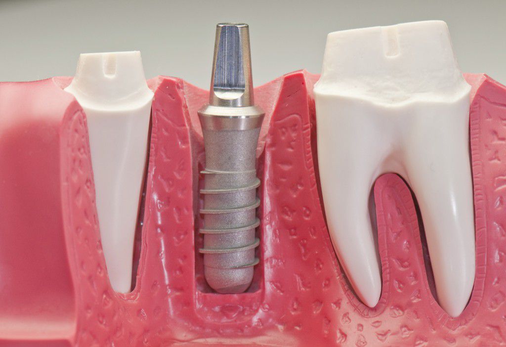 Bảo dưỡng Implant sau khi cấy ghép