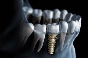 Các kỹ thuật cấy ghép Implant