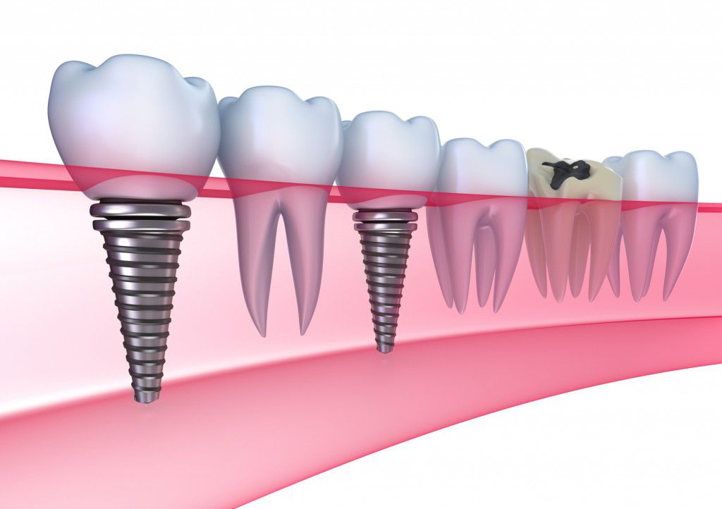 Chăm sóc sau cấy ghép Implant đúng cách