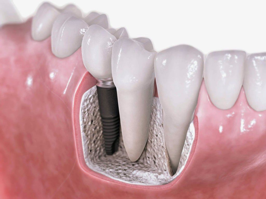 Phương pháp cấy ghép implant chỉ trong 1 ngày