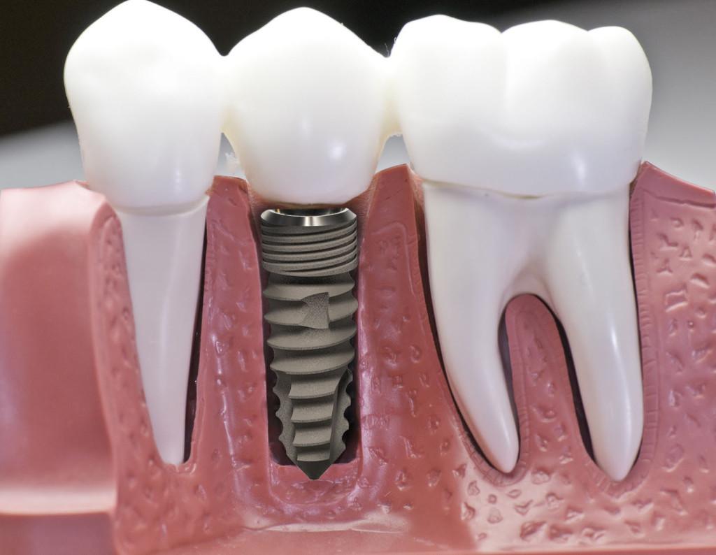 Có được niềng răng cho hàm có răng cấy ghép implant? 1