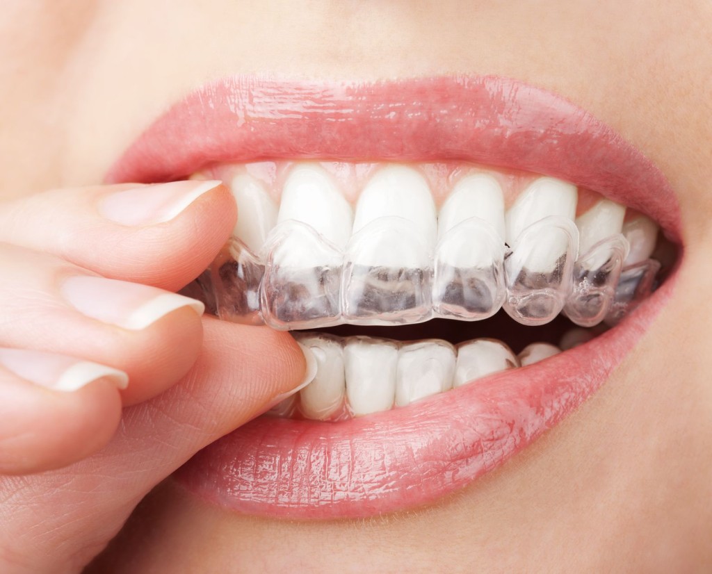 Đặc điểm và quy trình niềng răng Invisalign 1