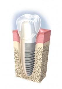 Cấy ghép răng Implant có ưu điểm gì?