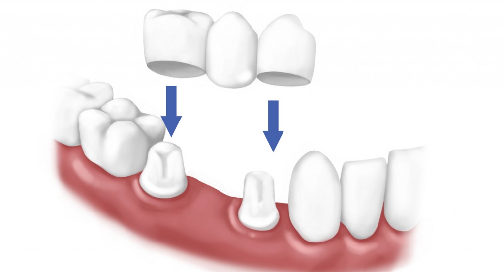 Sự khác nhau giữa cấy ghép implant và bọc răng sứ 1