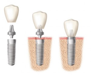 Răng implant có đau nhức khi trời lạnh?