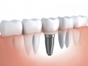 Ảnh hưởng của tuổi tác đến việc cấy ghép Implant?