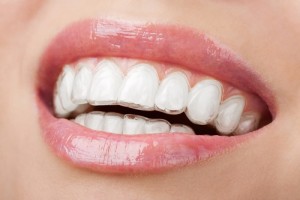 Niềng răng không mắc cài Invisalign giá bao nhiêu tiền?