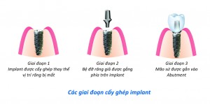 Trồng răng implant mất bao lâu ?