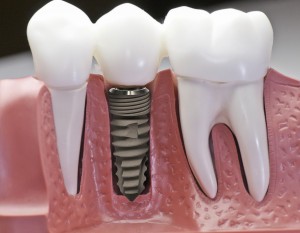 Quy trình cấy ghép implant