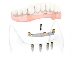 Cấy ghép implant nha khoa là gì ?