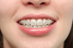 Chi phí niềng răng mắc cài tự đóng