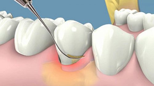 Chảy máu răng khi đánh răng có sao không? 3