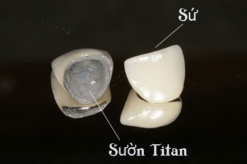 Bọc răng sứ titan có tốt không? Độ bền bao lâu?-3