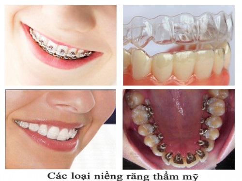 Niềng răng khớp cắn hở bằng cách nào nhanh hiệu quả-3