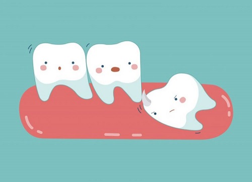 Răng khôn bị đau do đâu - Cách xử lý giúp giảm đau 1
