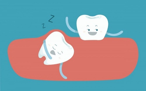 Răng khôn bị đau do đâu - Cách xử lý giúp giảm đau 3