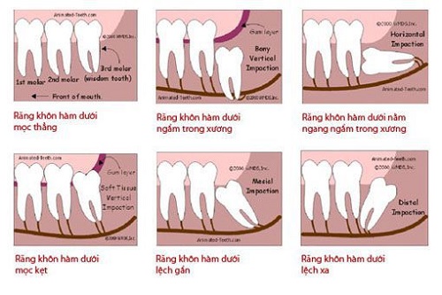 Răng khôn là gì? Khái quát và nội dung răng khôn 2