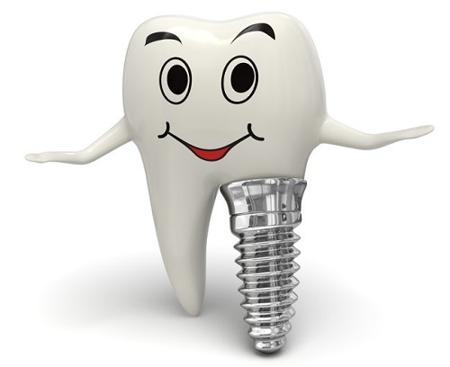 Cách chăm sóc răng sau khi cấy implant cho bạn 2