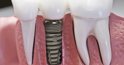 Cách chăm sóc răng sau khi cấy implant cho bạn 3