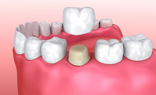 Thực hư câu chuyện trồng răng sứ có tốt không?-1