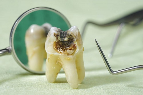 Răng khôn bị sâu nên nhổ hay trám là tốt nhất? 2