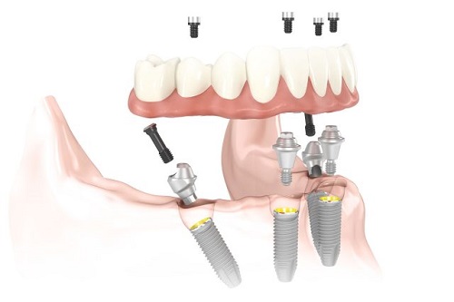 Trồng răng implant ở Cần Thơ an toàn hiệu quả cao-3