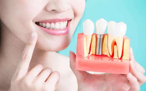 Trồng răng implant ở Cần Thơ an toàn hiệu quả cao-4