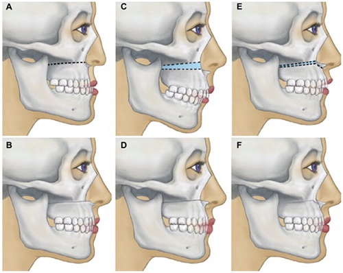 Niềng răng chỉnh hàm lệch hiệu quả không? 3