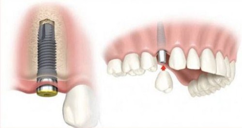 Trồng răng cấm hết bao nhiêu tiền? Tham khảo chi phí 3