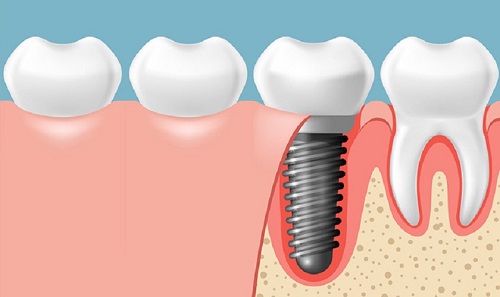 Trồng răng giả có đau không? Tham khảo từ chuyên gia 3